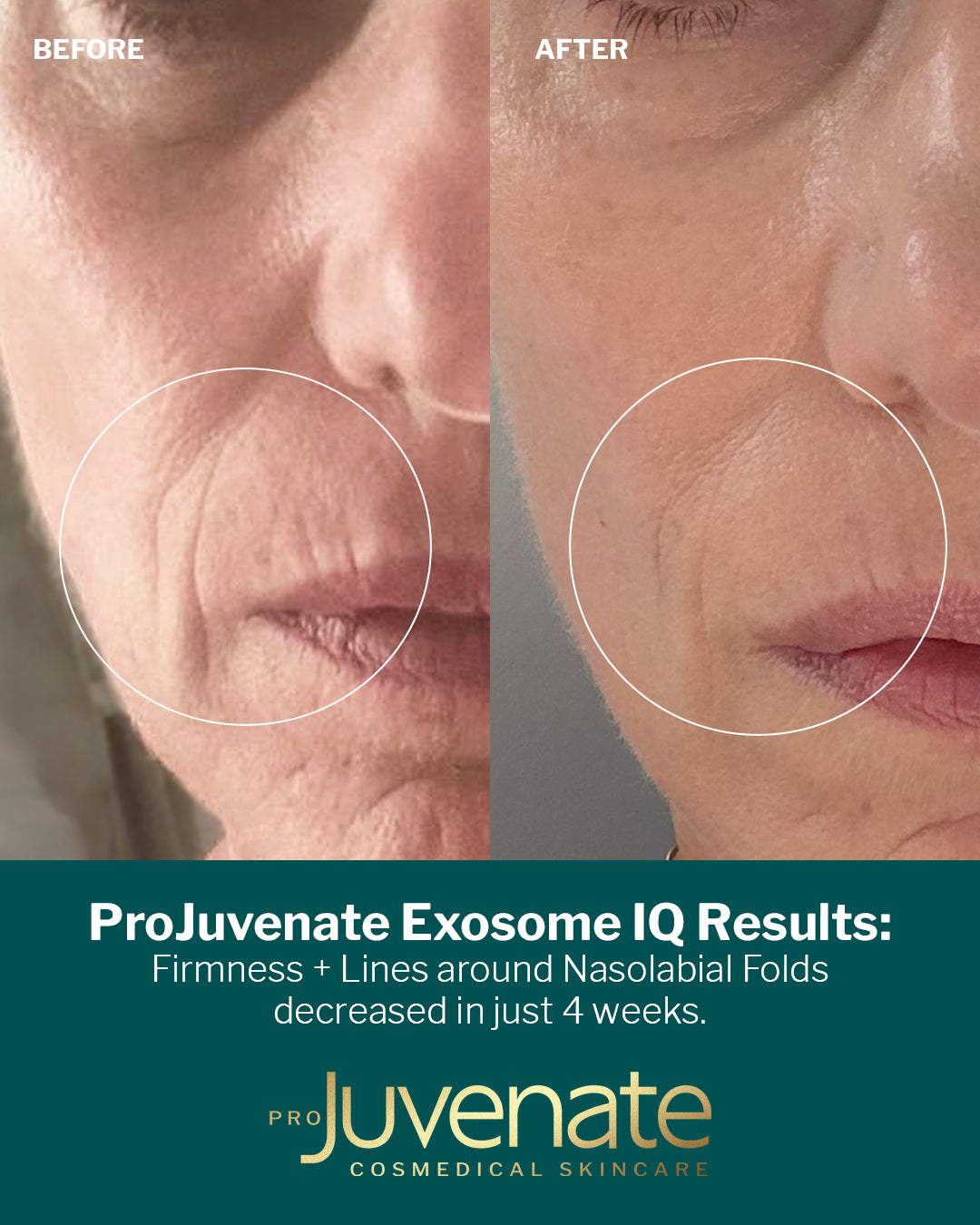 Exosome IQ with 180,000+ Bio-Needles